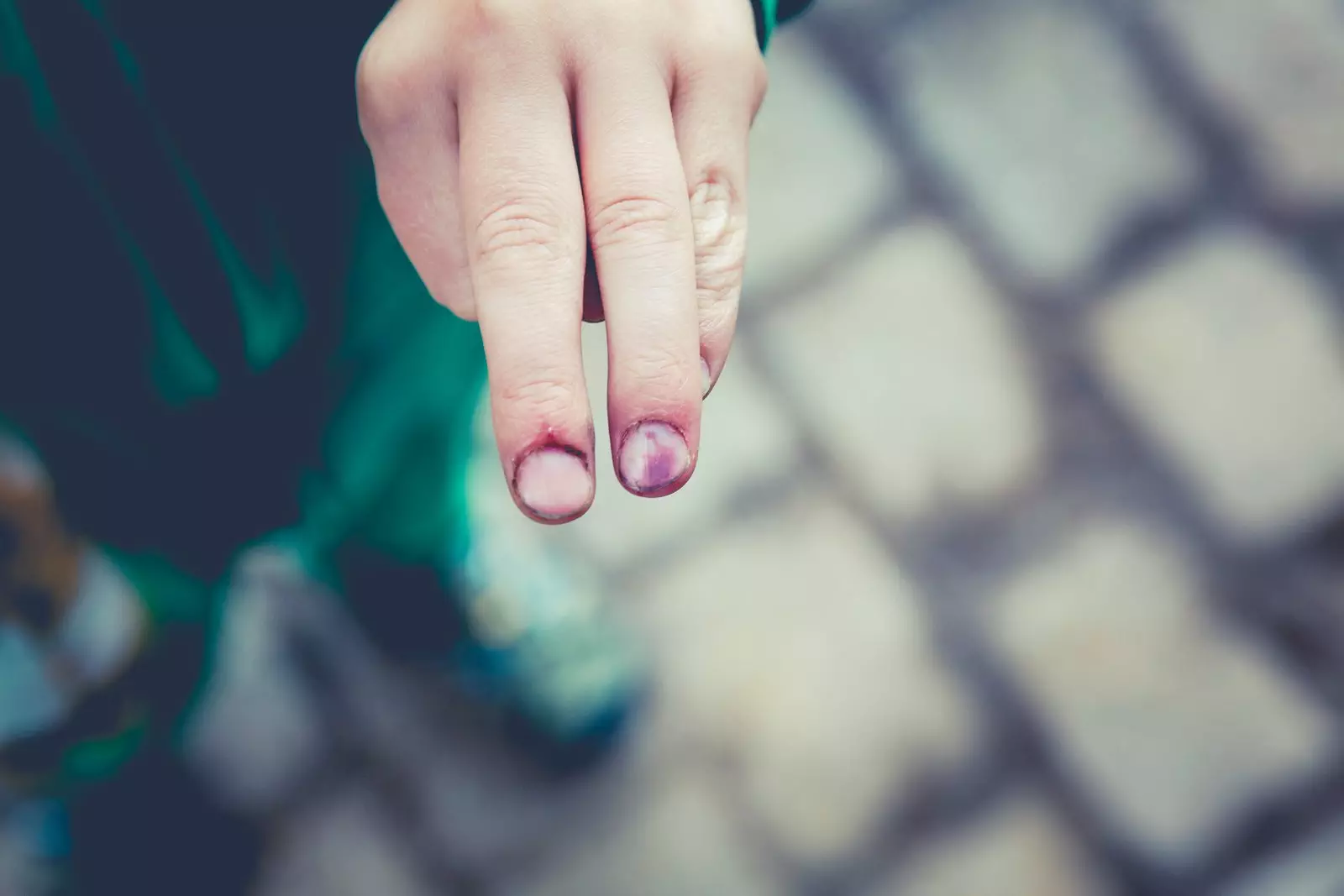 white spots-nail injury